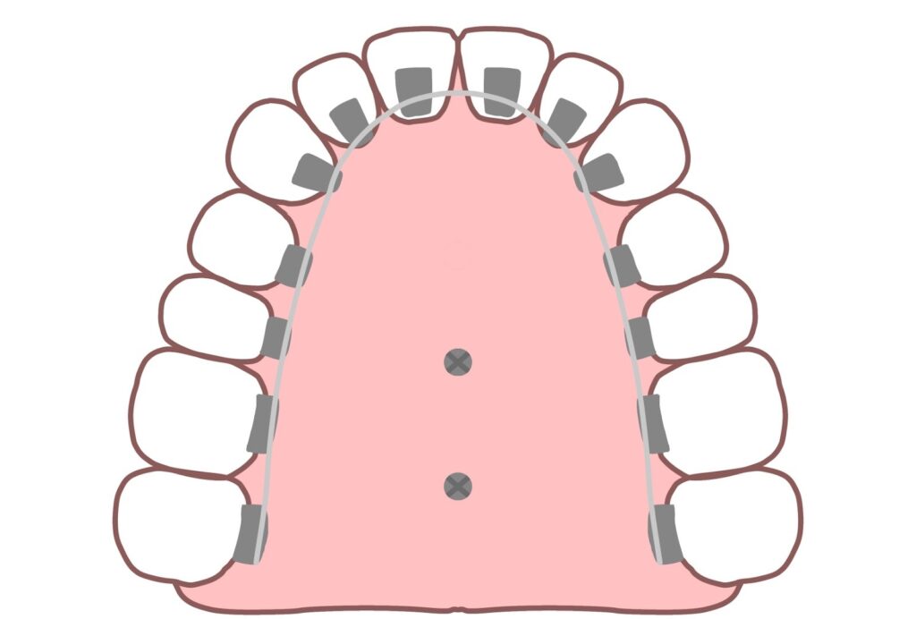歯科矯正用アンカースクリューとは？