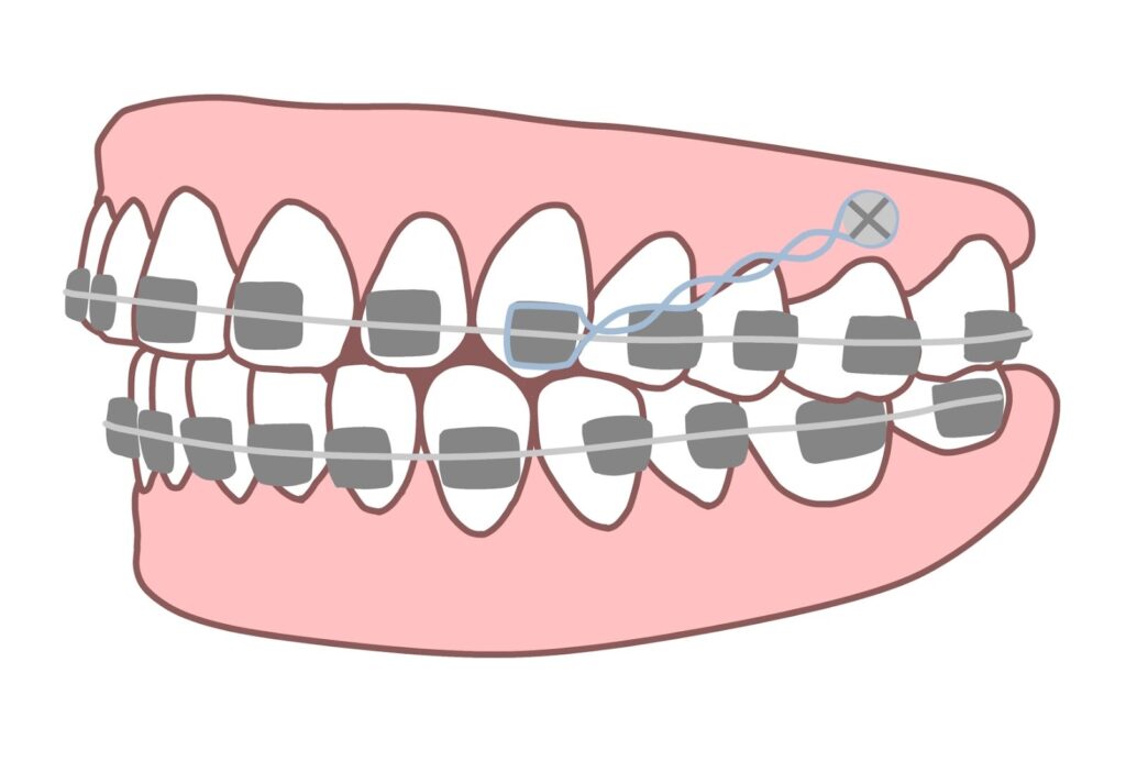 アンカースクリューの使用は“必要最小限”