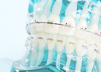 唇側・表側ワイヤー矯正歯科治療が向いている人
