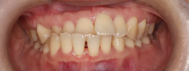 症例05 治療前の口元の写真