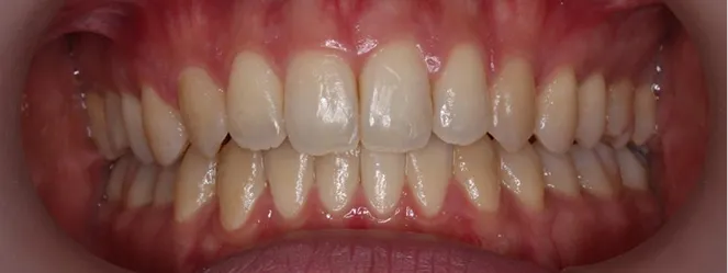 症例04 治療後の口元の写真