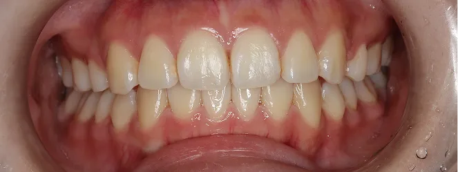 症例06 治療後の口元の写真