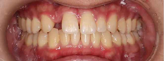 症例03 治療後の口元の写真