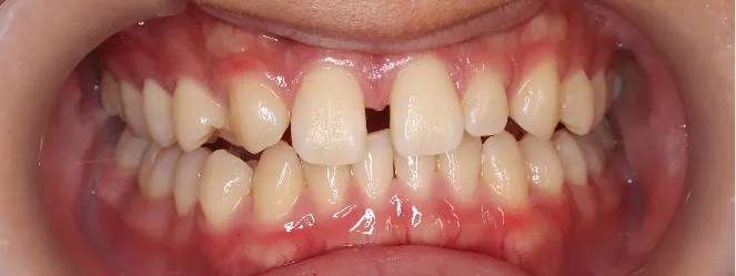 症例03 治療前の口元の写真