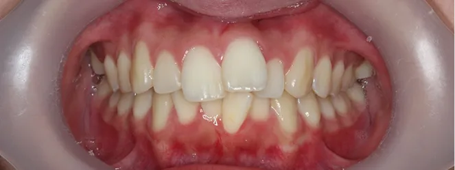 症例08 治療前の口元の写真