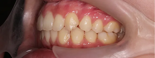 症例02 治療後の口元の写真