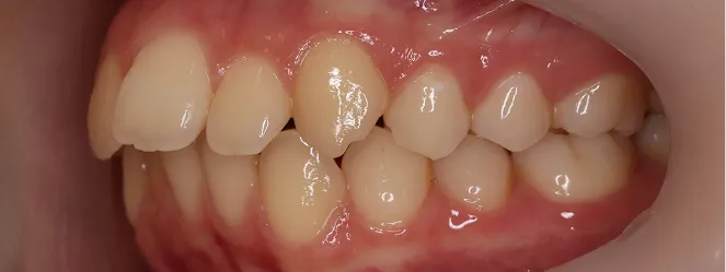 症例02 治療前の口元の写真