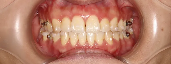 症例09 治療後の口元の写真