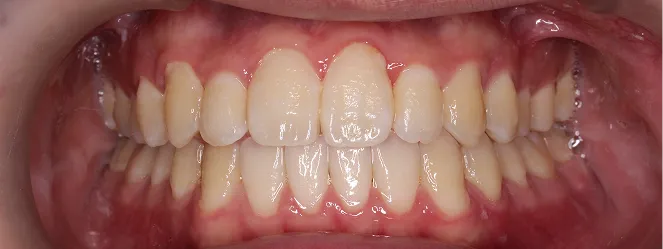 症例01 治療後の口元の写真