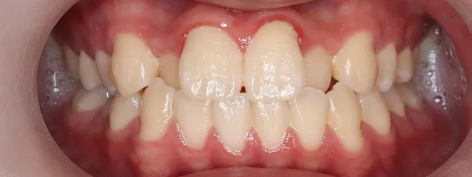 症例01 治療前の口元の写真