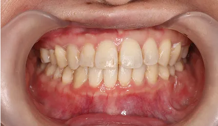 受け口・しゃくれ 治療後