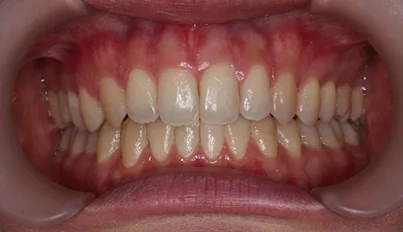 噛み合わせが深い 治療後