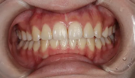 前歯が閉じられない 治療後