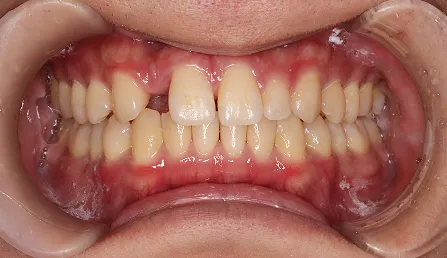 すきっ歯 治療後