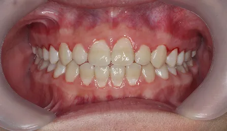 交叉咬合 治療後