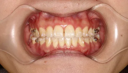 上下の前歯の中心線がずれている 治療後