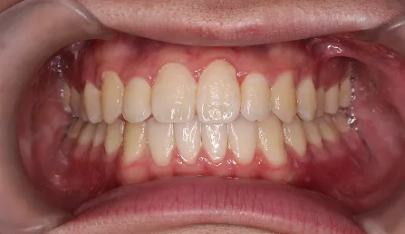 八重歯・歯並びがでこぼこ 治療後