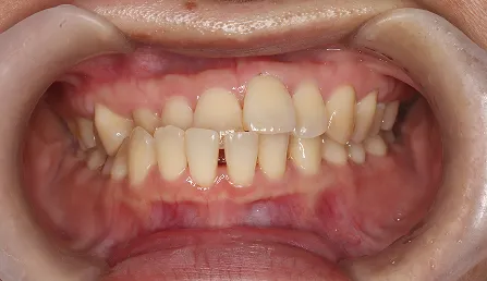 受け口・しゃくれ 治療前