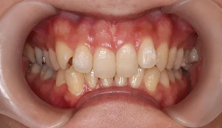 噛み合わせが深い 治療前