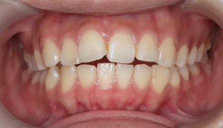 前歯が閉じられない 治療前