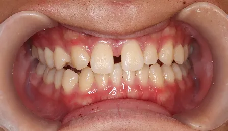 すきっ歯 治療前