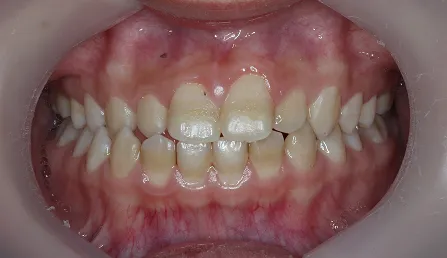 交叉咬合 治療前