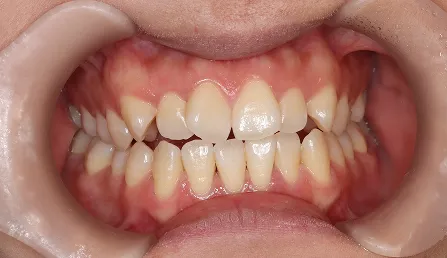 上下の前歯の中心線がずれている 治療前