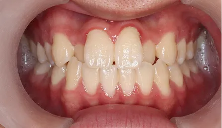 八重歯・歯並びがでこぼこ 治療前