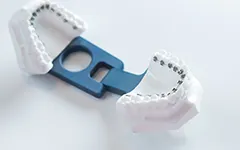 表側ワイヤー矯正