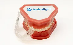 裏側ワイヤー矯正