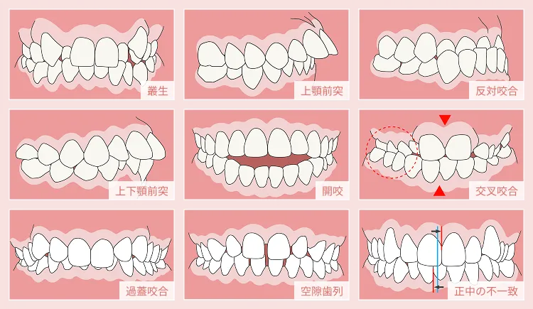 9種類の歯並びを分類
