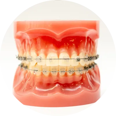 唇側・表側ワイヤー矯正