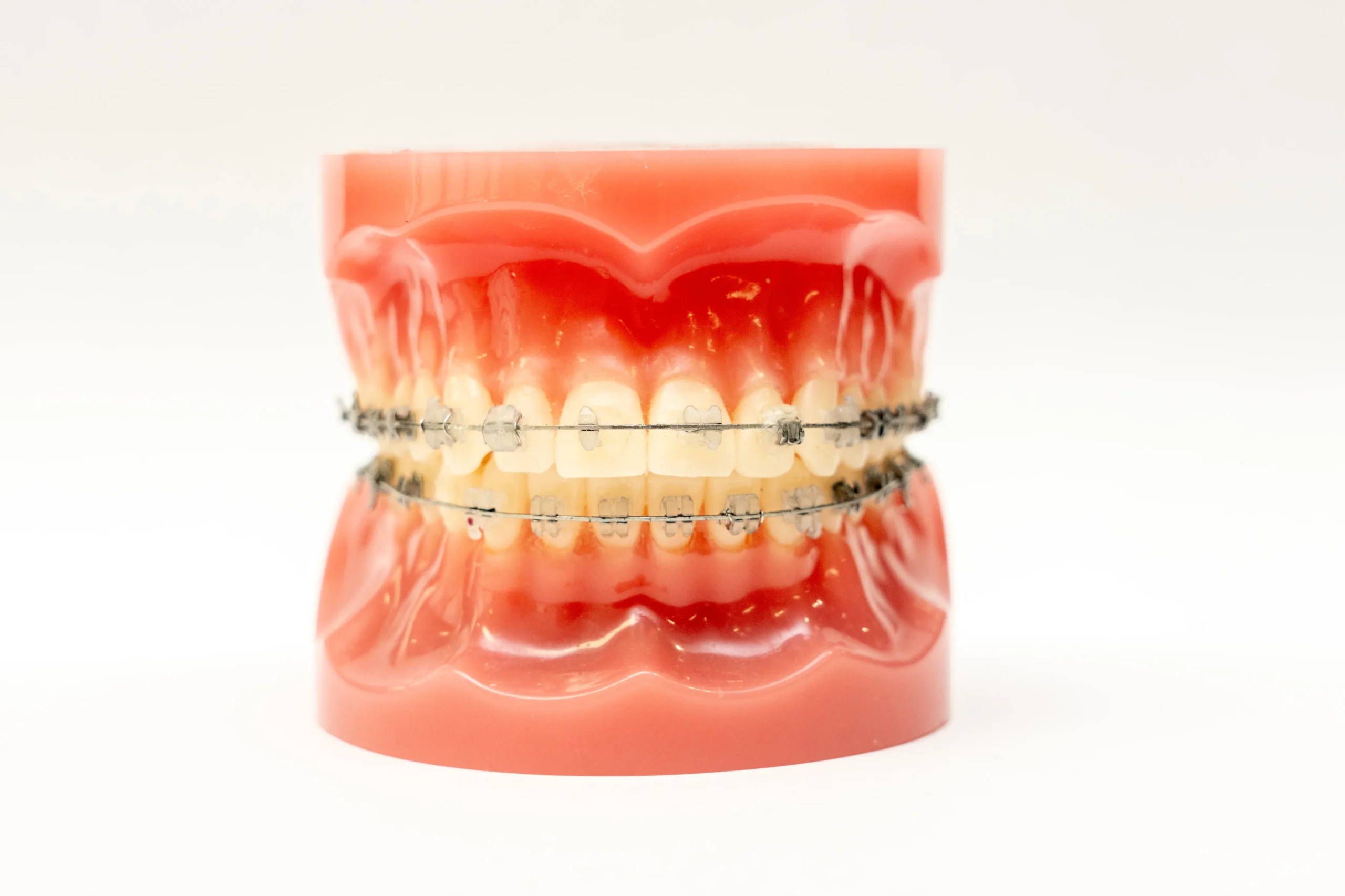 マウスピース矯正が対応できない難症例に対応